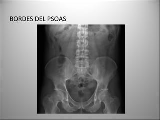 BORDES DEL PSOAS
 