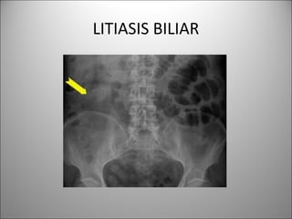 LITIASIS BILIAR
 