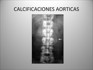 CALCIFICACIONES AORTICAS
 