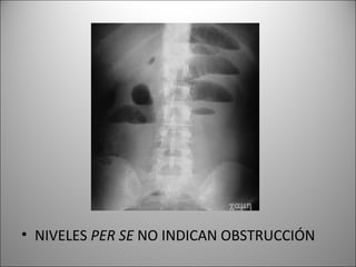 • NIVELES PER SE NO INDICAN OBSTRUCCIÓN
 