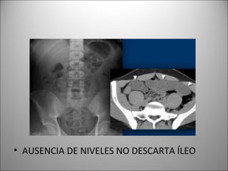 • AUSENCIA DE NIVELES NO DESCARTA ÍLEO
 