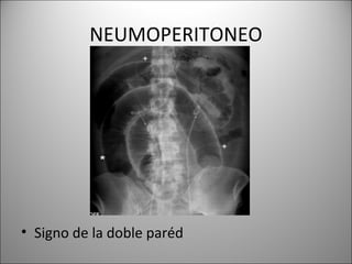 NEUMOPERITONEO
• Signo de la doble paréd
 
