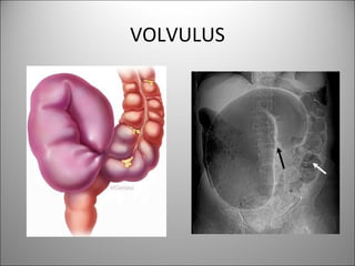 VOLVULUS
 