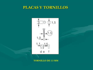 TORNILLO DE 1.5 MM
PLACAS Y TORNILLOS
 