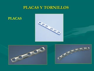 PLACAS Y TORNILLOS
PLACAS
 