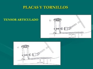 PLACAS Y TORNILLOS
TENSOR ARTICULADO
 