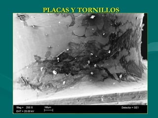 PLACAS Y TORNILLOS
 