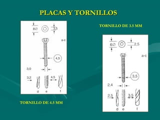 TORNILLO DE 3.5 MMTORNILLO DE 4.5 MM
PLACAS Y TORNILLOS
 