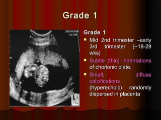 Grade 1
Grade 1
Grade 1
Grade 1
 Mid 2nd trimester –early
Mid 2nd trimester –early
3rd trimester (~18-29
3rd trimester (~18-29
wks)
wks)
 Subtle (thin) indentations
Subtle (thin) indentations
of chorionic plate.
of chorionic plate.
 Small, diffuse
Small, diffuse
calcifications
calcifications
(hyperechoic) randomly
(hyperechoic) randomly
dispersed in placenta
dispersed in placenta
 