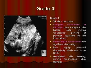 Grade 3
Grade 3
Grade 3
Grade 3
 39 wks – post dates
39 wks – post dates
 Complete indentations of
Complete indentations of
chorionic
chorionic plate through to the
plate through to the
basilar plate creating
basilar plate creating
“cotyledons” (portions of
“cotyledons” (portions of
placenta separated by the
placenta separated by the
indentations)
indentations)
 More irregular calcifications
More irregular calcifications with
with
significant shadowing
significant shadowing
 May signify placental
May signify placental
dysmaturity which can cause
dysmaturity which can cause
IUGR
IUGR
 Associated with smoking,
Associated with smoking,
chronic hypertension, SLE,
chronic hypertension, SLE,
diabetes
diabetes
 