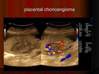 placental chorioangioma
placental chorioangioma
 