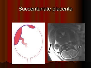 Succenturiate placenta
Succenturiate placenta
 