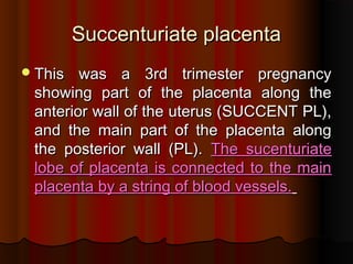 Succenturiate placenta
Succenturiate placenta
This was a 3rd trimester pregnancy
This was a 3rd trimester pregnancy
showing part of the placenta along the
showing part of the placenta along the
anterior wall of the uterus (SUCCENT PL),
anterior wall of the uterus (SUCCENT PL),
and the main part of the placenta along
and the main part of the placenta along
the posterior wall (PL).
the posterior wall (PL). The sucenturiate
The sucenturiate
lobe of placenta is connected to the main
lobe of placenta is connected to the main
placenta by a string of blood vessels.
placenta by a string of blood vessels.
 