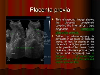 Placenta previa
Placenta previa
 This ultrasound image shows
This ultrasound image shows
the placenta completely
the placenta completely
covering the internal os , thus
covering the internal os , thus
diagnostic of
diagnostic of complete
complete
placenta previa
placenta previa.
.
 Follow up ultrasonography is
Follow up ultrasonography is
advisable in all cases of placenta
advisable in all cases of placenta
previa, to look for ascent of the
previa, to look for ascent of the
placenta to a higher position due
placenta to a higher position due
to the growth of the uterus
to the growth of the uterus.
. Such
Such
cases of placenta previa
cases of placenta previa (
(both
both
partial and complete
partial and complete)
) are
are in
in
danger of hemorrhage
danger of hemorrhage
(
(antepartum
antepartum)
) and are advised
and are advised
rest to prevent this
rest to prevent this.
.
 