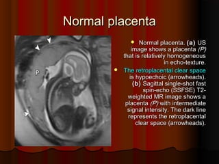Normal placenta
Normal placenta
 Normal placenta
Normal placenta.
. (
(a
a)
) US
US
image shows a placenta
image shows a placenta (
(P
P)
)
that is relatively homogeneous
that is relatively homogeneous
in echo
in echo-
-texture
texture.
.
 The
The retroplacental clear space
retroplacental clear space
is hypoechoic
is hypoechoic (
(arrowheads
arrowheads).
).
(
(b
b)
) Sagittal single
Sagittal single-
-shot fast
shot fast
spin
spin-
-echo
echo (
(SSFSE
SSFSE)
) T2-
T2-
weighted MR image shows a
weighted MR image shows a
placenta
placenta (
(P
P)
) with intermediate
with intermediate
signal intensity
signal intensity.
. The dark line
The dark line
represents the retroplacental
represents the retroplacental
clear space
clear space (
(arrowheads
arrowheads).
).
 
