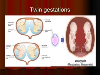 Twin gestations
Twin gestations
 