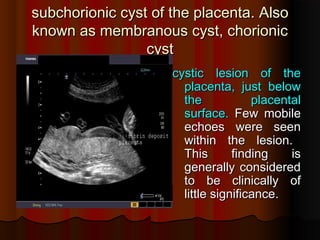 subchorionic cyst of the placenta
subchorionic cyst of the placenta.
. Also
Also
known as membranous cyst, chorionic
known as membranous cyst, chorionic
cyst
cyst
cystic lesion of the
cystic lesion of the
placenta, just below
placenta, just below
the placental
the placental
surface
surface.
. Few mobile
Few mobile
echoes were seen
echoes were seen
within the lesion
within the lesion.
.
This finding is
This finding is
generally considered
generally considered
to be clinically of
to be clinically of
little significance
little significance.
.
 