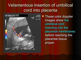 Velamentous insertion of umbilical
Velamentous insertion of umbilical
cord into placenta
cord into placenta
 These color doppler
These color doppler
images show
images show the
the
umbilical cord
umbilical cord
inserting into the
inserting into the
placental membranes
placental membranes
before reaching the
before reaching the
placental tissue
placental tissue
proper
proper.
.
 