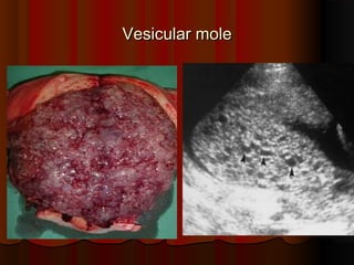 Vesicular mole
Vesicular mole
 