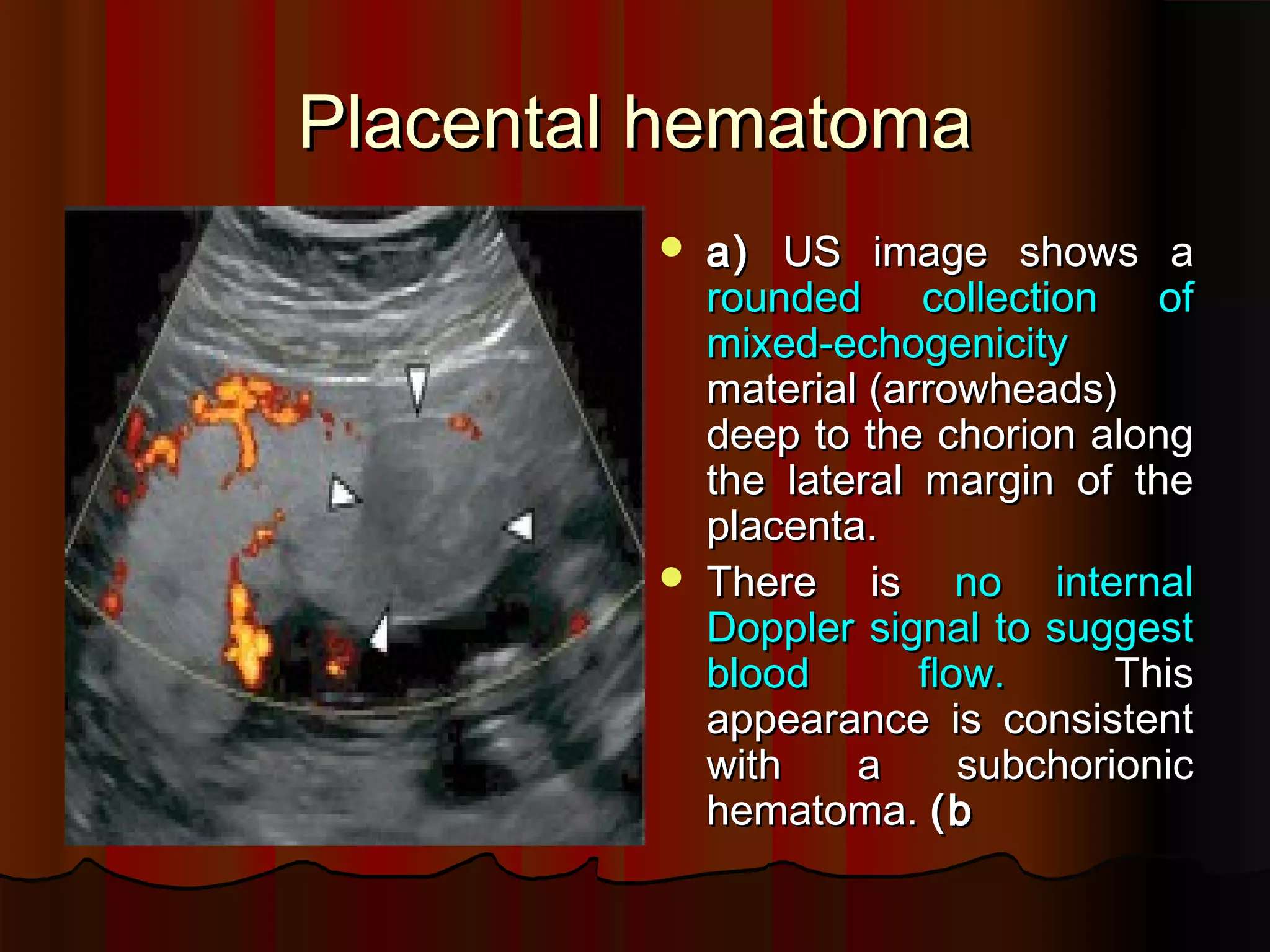 Placenta Ultrasound PPT