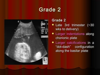 Grade 2Grade 2
Grade 2Grade 2
 Late 3rd trimester (~30Late 3rd trimester (~30
wks to delivery)wks to delivery)
 Larger indentationsLarger indentations alongalong
chorionic platechorionic plate
 Larger calcificationsLarger calcifications in ain a
“dot-dash” configuration“dot-dash” configuration
along the basilar platealong the basilar plate
 