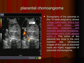 placental chorioangiomaplacental chorioangioma
 Sonography of the placenta inSonography of the placenta in
this 16 week pregnancy showsthis 16 week pregnancy shows
a large, solid mass, that is nona large, solid mass, that is non
calcific and shows mildcalcific and shows mild
vascularity (vascular) andvascularity (vascular) and
excludes placental hematomaexcludes placental hematoma..
and shows many cystic spacesand shows many cystic spaces
within itwithin it.. This tumor of theThis tumor of the
placenta lies close to the cordplacenta lies close to the cord
insertion siteinsertion site.. UltrasoundUltrasound
images of this type of placentalimages of this type of placental
mass are highly suggestive ofmass are highly suggestive of
placental chorioangiomaplacental chorioangioma..
 