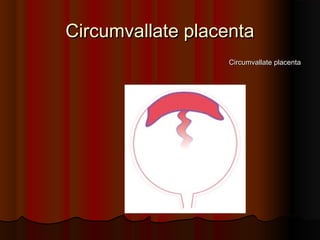 Circumvallate placentaCircumvallate placenta
Circumvallate placentaCircumvallate placenta
 
