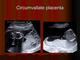 Circumvallate placentaCircumvallate placenta
 