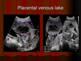 Placental venous lakePlacental venous lake
 