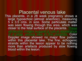Placental venous lakePlacental venous lake
This placenta, in a 28 week pregnancy shows aThis placenta, in a 28 week pregnancy shows a
large hypoechoiclarge hypoechoic ((almost anechoicalmost anechoic)), measuring, measuring
5 x 3.5 cms5 x 3.5 cms.. in sizein size.. Some particulate matterSome particulate matter
was seen flowing through this area, which waswas seen flowing through this area, which was
closer to the fetal surface of the placentacloser to the fetal surface of the placenta.. TheseThese
ultrasound images suggest a typical appearanceultrasound images suggest a typical appearance
of a large venous lake in the placentaof a large venous lake in the placenta.. ColorColor
Doppler image showed no major flow patternDoppler image showed no major flow pattern
within this placental lakewithin this placental lake.. The fine, echogenicThe fine, echogenic
strands within the lesion appear to be nothingstrands within the lesion appear to be nothing
more than artefacts produced by slow flowingmore than artefacts produced by slow flowing
blood within the lesionblood within the lesion..
 