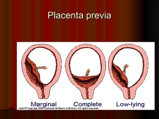 Placenta previaPlacenta previa
 