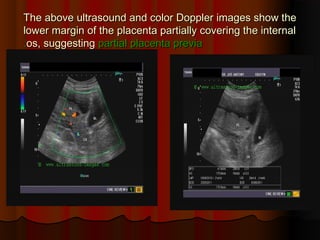 The above ultrasound and color Doppler images show theThe above ultrasound and color Doppler images show the
lower margin of the placenta partially covering the internallower margin of the placenta partially covering the internal
os, suggestingos, suggesting partial placenta previapartial placenta previa..
 
