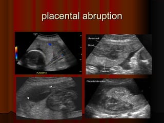 placental abruptionplacental abruption
 