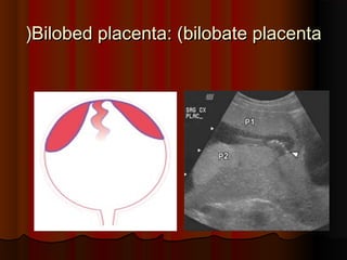 Bilobed placentaBilobed placenta: (: (bilobate placentabilobate placenta((
 