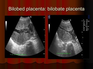 Bilobed placentaBilobed placenta:: bilobate placentabilobate placenta
 