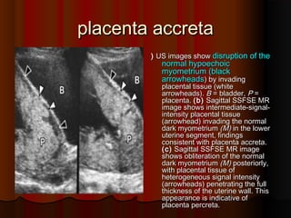placenta accretaplacenta accreta
)) US images showUS images show disruption of thedisruption of the
normal hypoechoicnormal hypoechoic
myometriummyometrium ((blackblack
arrowheadsarrowheads)) by invadingby invading
placental tissueplacental tissue ((whitewhite
arrowheadsarrowheads).). BB == bladderbladder,, PP ==
placentaplacenta.. ((bb)) Sagittal SSFSE MRSagittal SSFSE MR
image shows intermediateimage shows intermediate--signalsignal--
intensity placental tissueintensity placental tissue
((arrowheadarrowhead)) invading the normalinvading the normal
dark myometriumdark myometrium ((MM)) in the lowerin the lower
uterine segment, findingsuterine segment, findings
consistent with placenta accretaconsistent with placenta accreta..
((cc)) Sagittal SSFSE MR imageSagittal SSFSE MR image
shows obliteration of the normalshows obliteration of the normal
dark myometriumdark myometrium ((MM)) posteriorly,posteriorly,
with placental tissue ofwith placental tissue of
heterogeneous signal intensityheterogeneous signal intensity
((arrowheadsarrowheads)) penetrating the fullpenetrating the full
thickness of the uterine wallthickness of the uterine wall.. ThisThis
appearance is indicative ofappearance is indicative of
placenta percretaplacenta percreta..
 