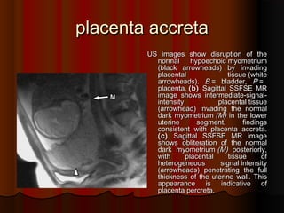 placenta accretaplacenta accreta
US images show disruption of theUS images show disruption of the
normal hypoechoic myometriumnormal hypoechoic myometrium
((black arrowheadsblack arrowheads)) by invadingby invading
placental tissueplacental tissue ((whitewhite
arrowheadsarrowheads).). BB == bladderbladder,, PP ==
placentaplacenta.. ((bb)) Sagittal SSFSE MRSagittal SSFSE MR
image shows intermediateimage shows intermediate--signalsignal--
intensity placental tissueintensity placental tissue
((arrowheadarrowhead)) invading the normalinvading the normal
dark myometriumdark myometrium ((MM)) in the lowerin the lower
uterine segment, findingsuterine segment, findings
consistent with placenta accretaconsistent with placenta accreta..
((cc)) Sagittal SSFSE MR imageSagittal SSFSE MR image
shows obliteration of the normalshows obliteration of the normal
dark myometriumdark myometrium ((MM)) posteriorly,posteriorly,
with placental tissue ofwith placental tissue of
heterogeneous signal intensityheterogeneous signal intensity
((arrowheadsarrowheads)) penetrating the fullpenetrating the full
thickness of the uterine wallthickness of the uterine wall.. ThisThis
appearance is indicative ofappearance is indicative of
placenta percretaplacenta percreta..
 