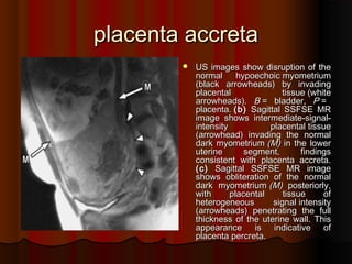 placenta accretaplacenta accreta
 US images show disruption of theUS images show disruption of the
normal hypoechoic myometriumnormal hypoechoic myometrium
((black arrowheadsblack arrowheads)) by invadingby invading
placental tissueplacental tissue ((whitewhite
arrowheadsarrowheads).). BB == bladderbladder,, PP ==
placentaplacenta.. ((bb)) Sagittal SSFSE MRSagittal SSFSE MR
image shows intermediateimage shows intermediate--signalsignal--
intensity placental tissueintensity placental tissue
((arrowheadarrowhead)) invading the normalinvading the normal
dark myometriumdark myometrium ((MM)) in the lowerin the lower
uterine segment, findingsuterine segment, findings
consistent with placenta accretaconsistent with placenta accreta..
((cc)) Sagittal SSFSE MR imageSagittal SSFSE MR image
shows obliteration of the normalshows obliteration of the normal
dark myometriumdark myometrium ((MM)) posteriorly,posteriorly,
with placental tissue ofwith placental tissue of
heterogeneous signal intensityheterogeneous signal intensity
((arrowheadsarrowheads)) penetrating the fullpenetrating the full
thickness of the uterine wallthickness of the uterine wall.. ThisThis
appearance is indicative ofappearance is indicative of
placenta percretaplacenta percreta..
 