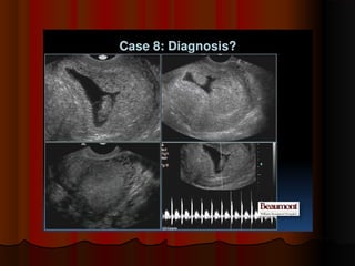 Placenta ultrasound