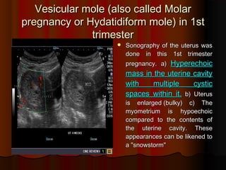Vesicular moleVesicular mole ((also called Molaralso called Molar
pregnancy or Hydatidiform molepregnancy or Hydatidiform mole)) in 1stin 1st
trimestertrimester
 Sonography of the uterus wasSonography of the uterus was
done in this 1st trimesterdone in this 1st trimester
pregnancypregnancy.. aa)) HyperechoicHyperechoic
mass in the uterine cavitymass in the uterine cavity
with multiple cysticwith multiple cystic
spaces within itspaces within it.. bb)) UterusUterus
is enlargedis enlarged ((bulkybulky)) cc)) TheThe
myometrium is hypoechoicmyometrium is hypoechoic
compared to the contents ofcompared to the contents of
the uterine cavitythe uterine cavity.. TheseThese
appearances can be likened toappearances can be likened to
aa ""snowstormsnowstorm""
 