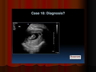 Placenta ultrasound