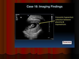 Placenta ultrasound
