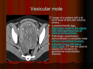 Vesicular moleVesicular mole
CT image of a patient with aCT image of a patient with a ββ--
hCG level of 620,000 mIUhCG level of 620,000 mIU//mLmL
shows :shows :
 a predominantlya predominantly lowlow--
attenuation mass in the uterusattenuation mass in the uterus
with heterogeneous foci ofwith heterogeneous foci of
internal enhancementinternal enhancement..
 Pathologic examinationPathologic examination
demonstrated a complete moledemonstrated a complete mole
without myometrial invasionwithout myometrial invasion..
 enlarged ovary with thecaenlarged ovary with theca
lutein cystslutein cysts.. CT can be used toCT can be used to
assess for invasion byassess for invasion by
gestational trophoblasticgestational trophoblastic
diseasedisease..
 