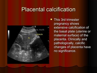 Placental calcificationPlacental calcification
 This 3rd trimesterThis 3rd trimester
pregnancy showspregnancy shows
extensive calcification ofextensive calcification of
the basal platethe basal plate ((uterine oruterine or
maternal surfacematernal surface)) of theof the
placentaplacenta.. Clinically andClinically and
pathologically, calcificpathologically, calcific
changes of placenta havechanges of placenta have
no significanceno significance..
 