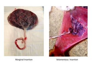 Velamentous InsertionMarginal Insertion
 