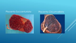 Placenta Succenturiata Placenta Circumvellata
 