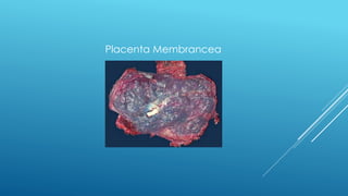 Placenta Membrancea
 