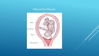Placenta Previa
 