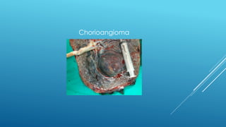 Chorioangioma
 