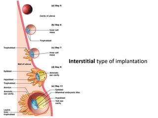 Interstitial type of implantation
 